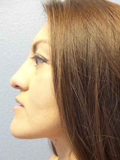 Rhinoplasty Before & After Patient #9848