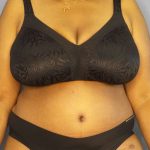 High BMI (Larger Patients) Surgery Before & After Patient #10409