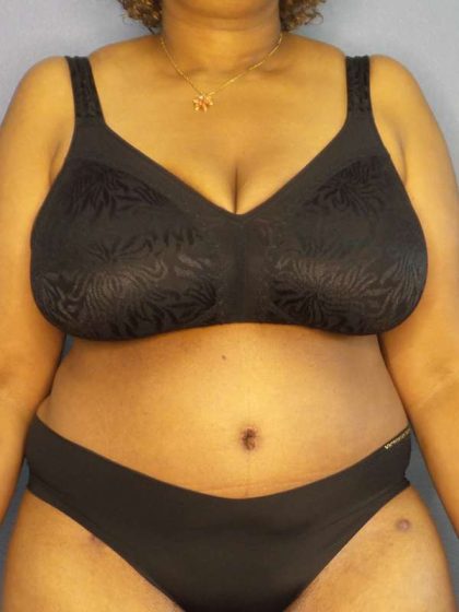 High BMI (Larger Patients) Surgery Before & After Patient #10409