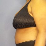 Abdominoplasty Before & After Patient #3724