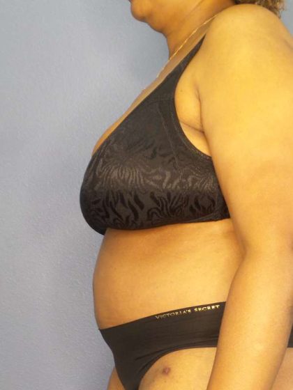 High BMI (Larger Patients) Surgery Before & After Patient #10409
