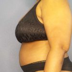 Abdominoplasty Before & After Patient #3724