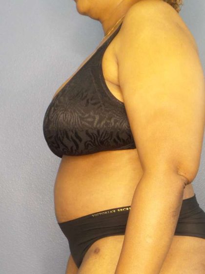 High BMI (Larger Patients) Surgery Before & After Patient #10409