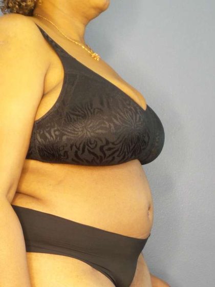High BMI (Larger Patients) Surgery Before & After Patient #10409