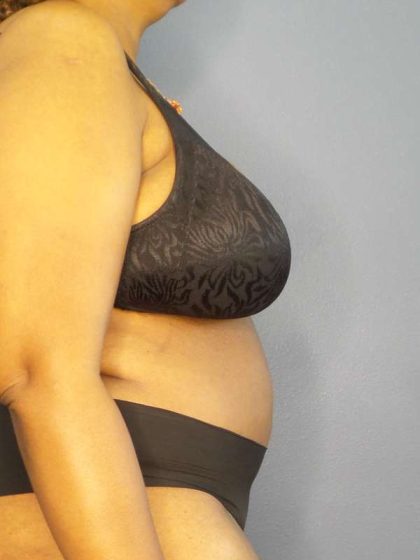 High BMI (Larger Patients) Surgery Before & After Patient #10409