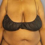 Abdominoplasty Before & After Patient #3724