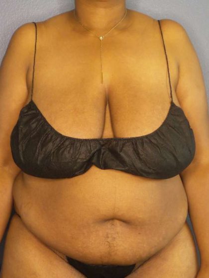High BMI (Larger Patients) Surgery Before & After Patient #10409