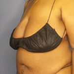 Abdominoplasty Before & After Patient #3724