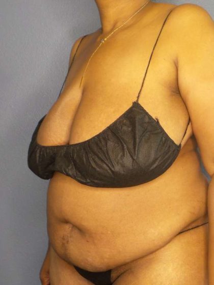 High BMI (Larger Patients) Surgery Before & After Patient #10409