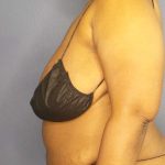 Abdominoplasty Before & After Patient #3724