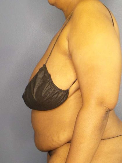 High BMI (Larger Patients) Surgery Before & After Patient #10409