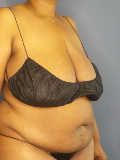 High BMI (Larger Patients) Surgery Before & After Patient #10409