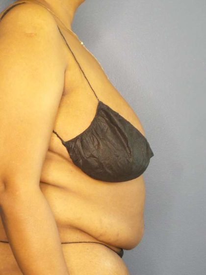 High BMI (Larger Patients) Surgery Before & After Patient #10409