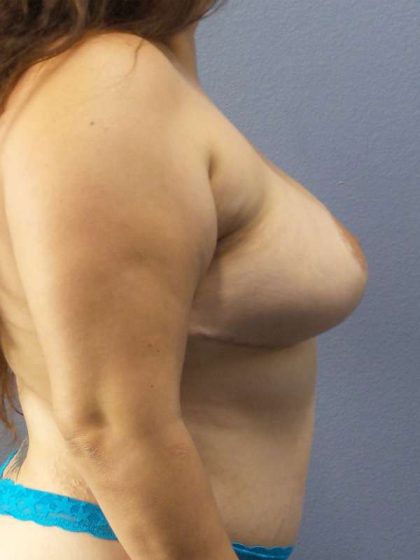 Breast Augmentation Revision (Breast Enlargement Repair) Before & After Patient #7239