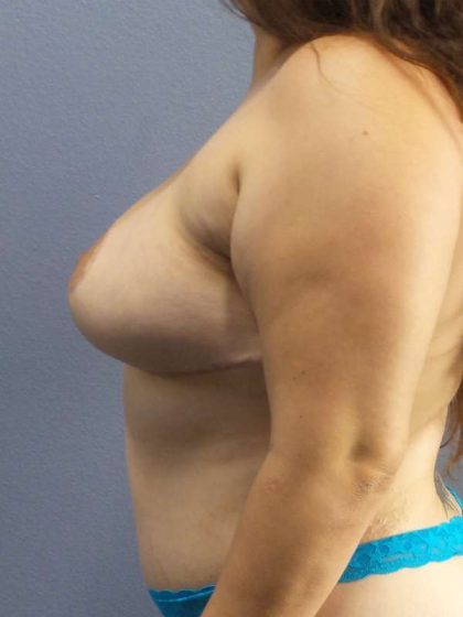 Breast Augmentation Revision (Breast Enlargement Repair) Before & After Patient #7239