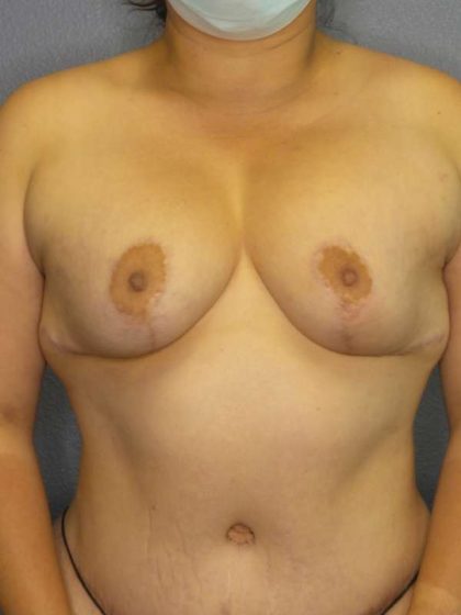 Breast Augmentation Revision (Breast Enlargement Repair) Before & After Patient #7239