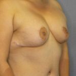 Breast Augmentation Revision (Breast Enlargement Repair) Before & After Patient #7239