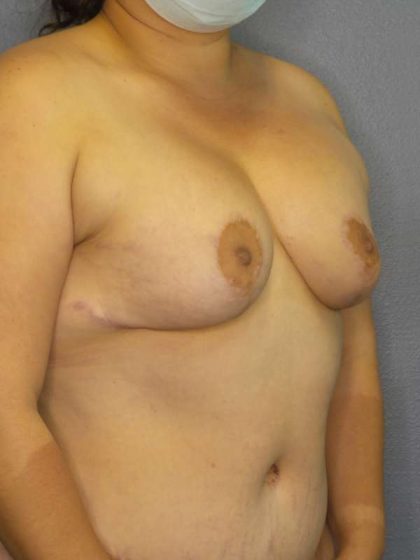 Breast Augmentation Revision (Breast Enlargement Repair) Before & After Patient #7239