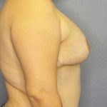 Breast Augmentation Revision (Breast Enlargement Repair) Before & After Patient #7239