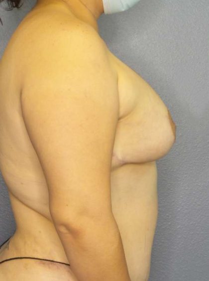 Breast Augmentation Revision (Breast Enlargement Repair) Before & After Patient #7239