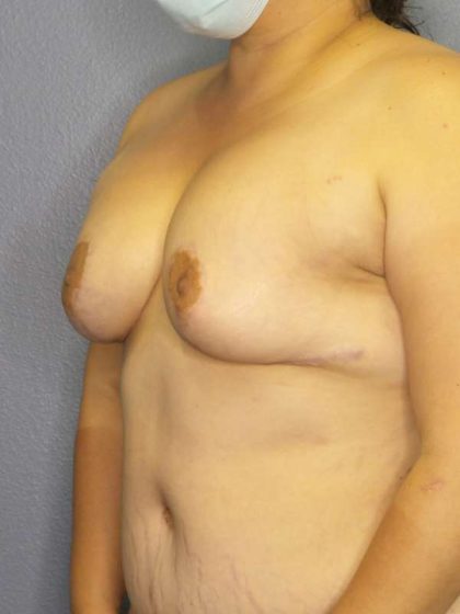 Breast Augmentation Revision (Breast Enlargement Repair) Before & After Patient #7239