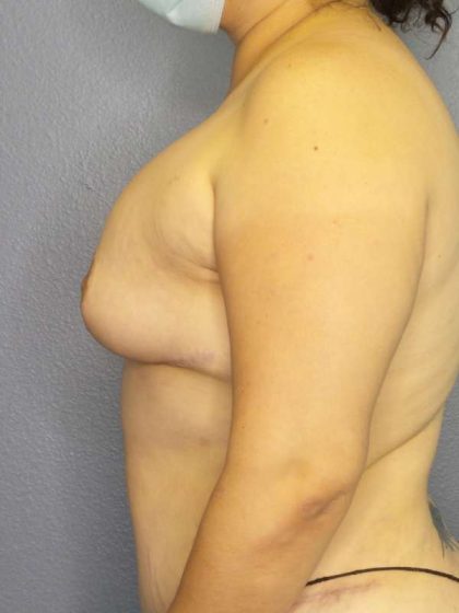 Breast Augmentation Revision (Breast Enlargement Repair) Before & After Patient #7239