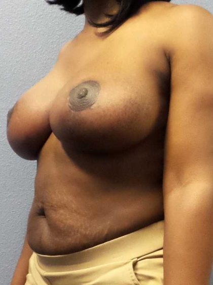 Breast Reduction Before & After Patient #7465