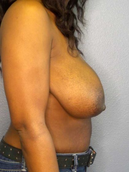 Breast Reduction Before & After Patient #7465