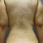 Liposuction Female Before & After Patient #7784