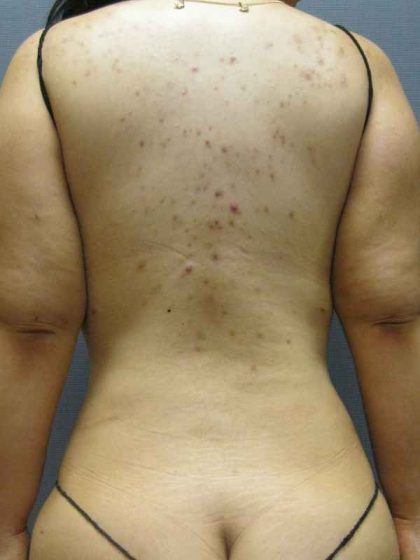 Liposuction Female Before & After Patient #7784