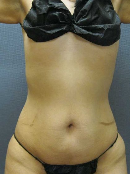 Liposuction Female Before & After Patient #7784