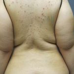 Liposuction Female Before & After Patient #7784