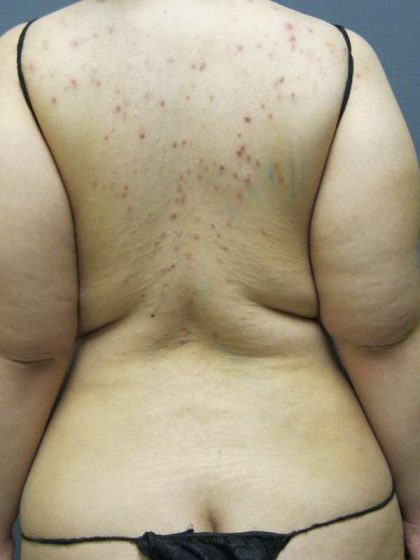 Liposuction Female Before & After Patient #7784