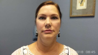 Filler Before & After Patient #7596