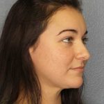 Liposuction of the Neck Before & After Patient #8344