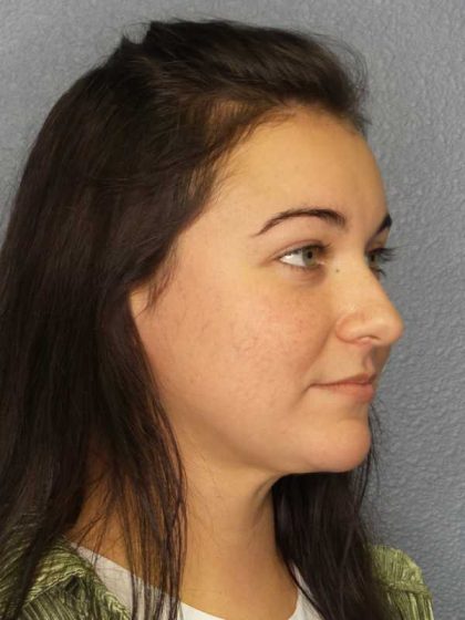 Liposuction of the Neck Before & After Patient #8344