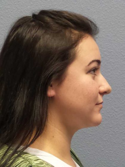 Liposuction of the Neck Before & After Patient #8344