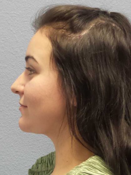 Liposuction of the Neck Before & After Patient #8344