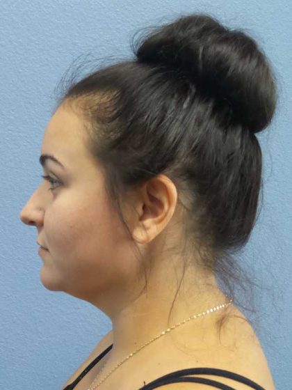 Liposuction of the Neck Before & After Patient #8344