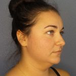 Liposuction of the Neck Before & After Patient #8344