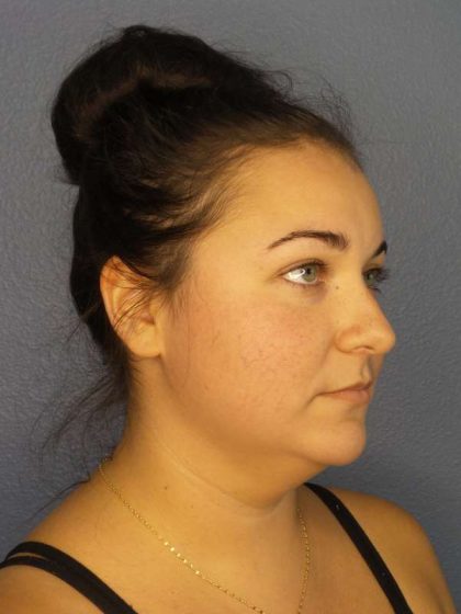 Liposuction of the Neck Before & After Patient #8344