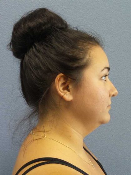 Liposuction of the Neck Before & After Patient #8344