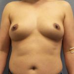 Breast Augmentation Before & After Patient #6277