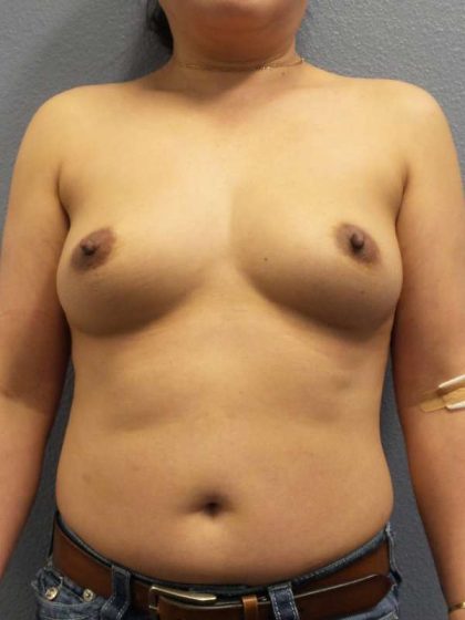 Breast Augmentation Before & After Patient #6277