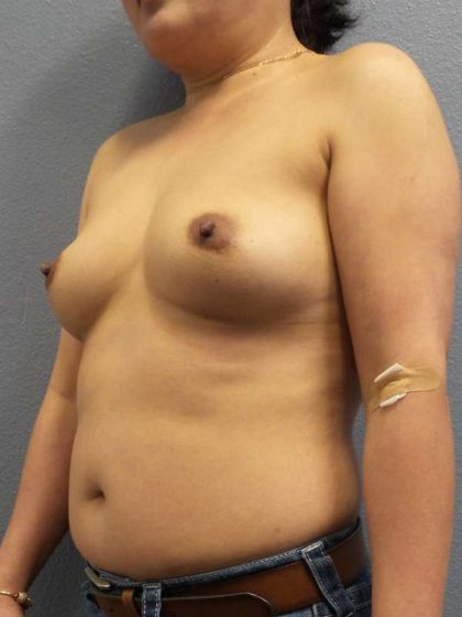 Breast Augmentation Before & After Patient #6277