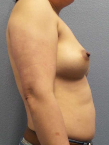 Breast Augmentation Before & After Patient #6277