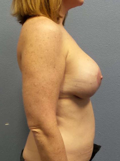 Augmentation Mastopexy Revision Before & After Patient #4650