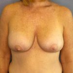 Augmentation Mastopexy Revision Before & After Patient #4650