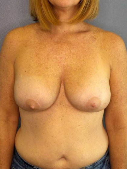 Augmentation Mastopexy Revision Before & After Patient #4650