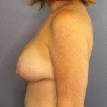 Augmentation Mastopexy Revision Before & After Patient #4650